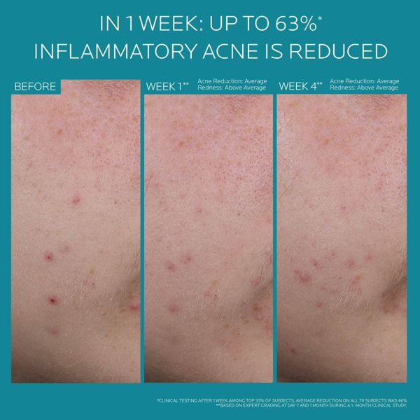 La Roche Posay Effaclar BPO Acne Treatment - Travel Size - 1.35 fl oz