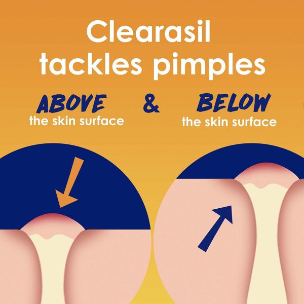 Clearasil Stubborn Acne Control 5in1 Daily Pads - 90ct