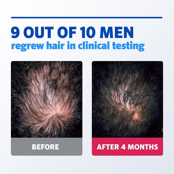 Rogaine Mens' 5% Minoxidil Foam for Hair Regrowth - 6.33oz