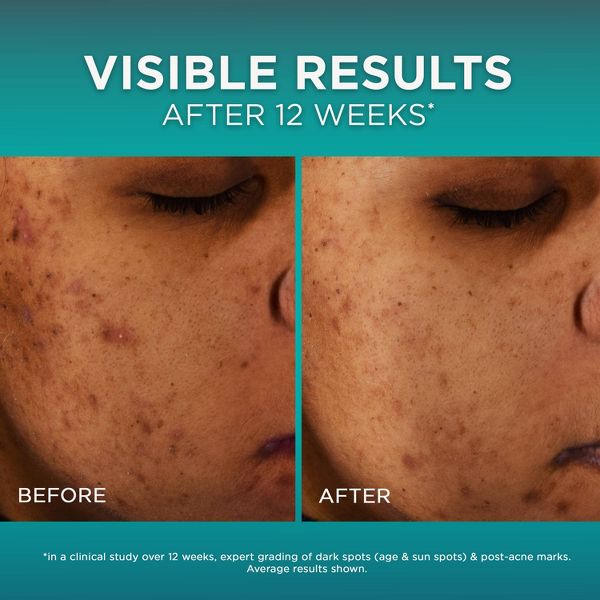 L'Oreal Paris Bright Reveal 12% Niacinamide Dark Spot Serum - 1 floz