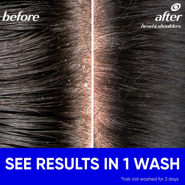 Head & Shoulders Anti-Dandruff Treatment, Classic Clean for Daily Use, Paraben-Free 2-in-1 Shampoo and Conditioner - 28.2 fl oz