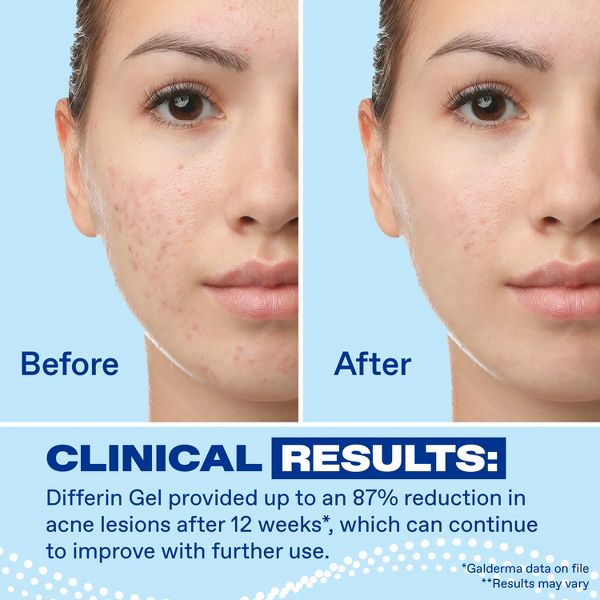 Differin Retinoid Adapalene Gel 0.1% Acne Treatment for Face and Body - 15g