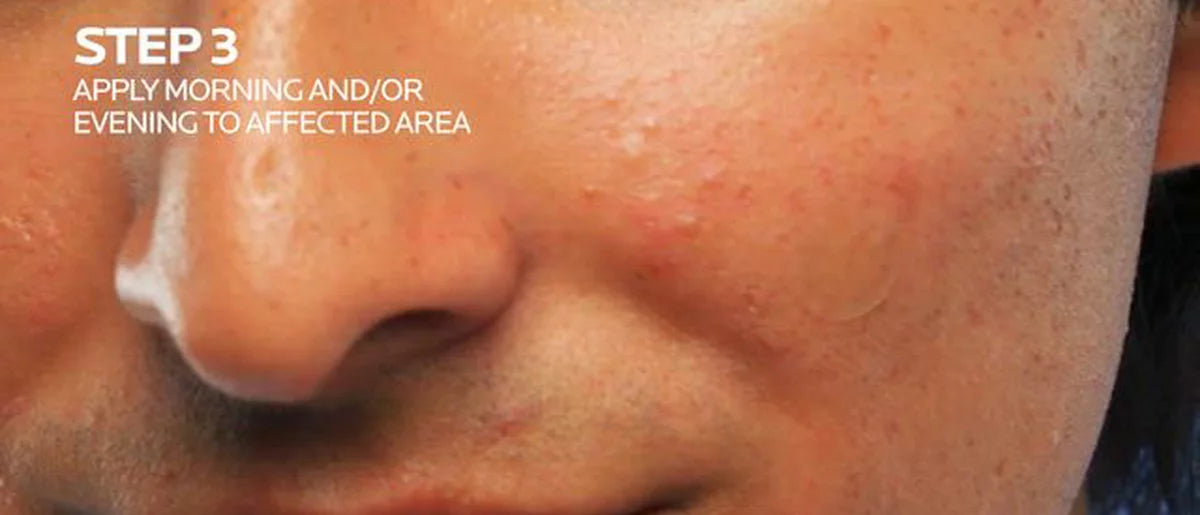 La Roche Posay Effaclar Unspot Acne Pimple Patches - 22ct