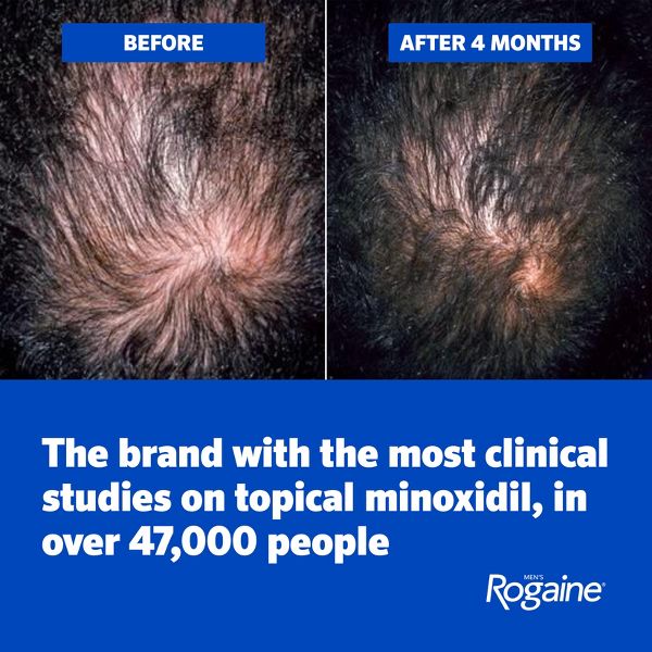 Rogaine Mens' 5% Minoxidil Foam for Hair Regrowth - 6.33oz